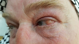 مركز ارشاد الكريعات: نازح من الفلوجة بحاجة الى مساعداتكم لأجراء عملية جراحية في عينيه