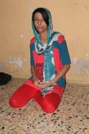 بغداد-مدينة الصدر :فتاة بعمر الزهور تعرضت الى حروق من الدرجه الاولى تحتاج الى اجراء عمليه تجميليه