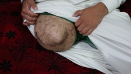 فرع البصرة :  المتعفف الشاب (محمود.ن.ع) تعرض لبتر في ساقه 